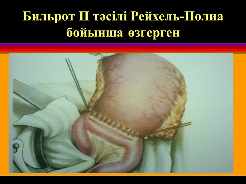 Бильрот II тәсілі Рейхель-Полиа бойынша өзгерген